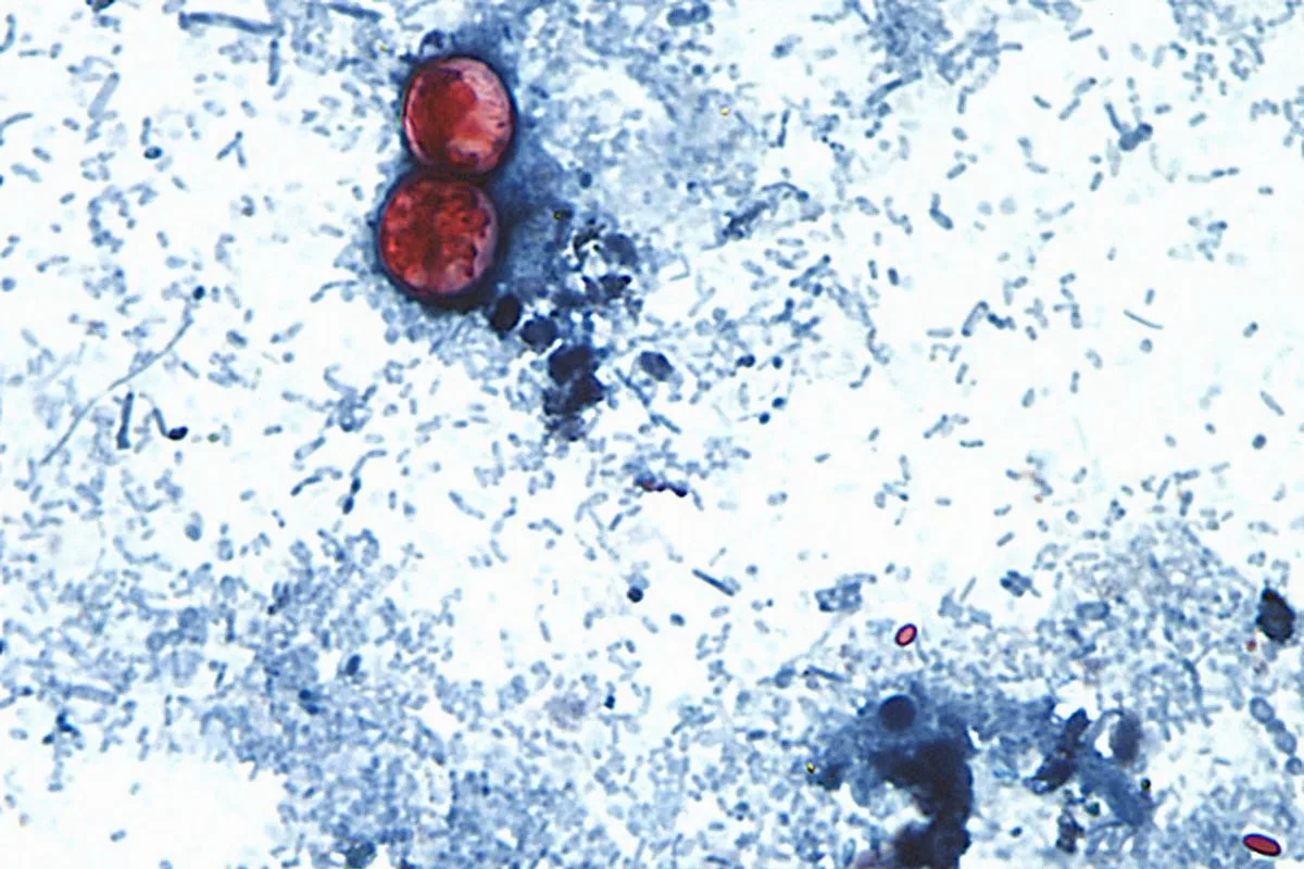 Cyclospora Outbreak Linked to Iceberg Lettuce Expands to Three More U.S. States