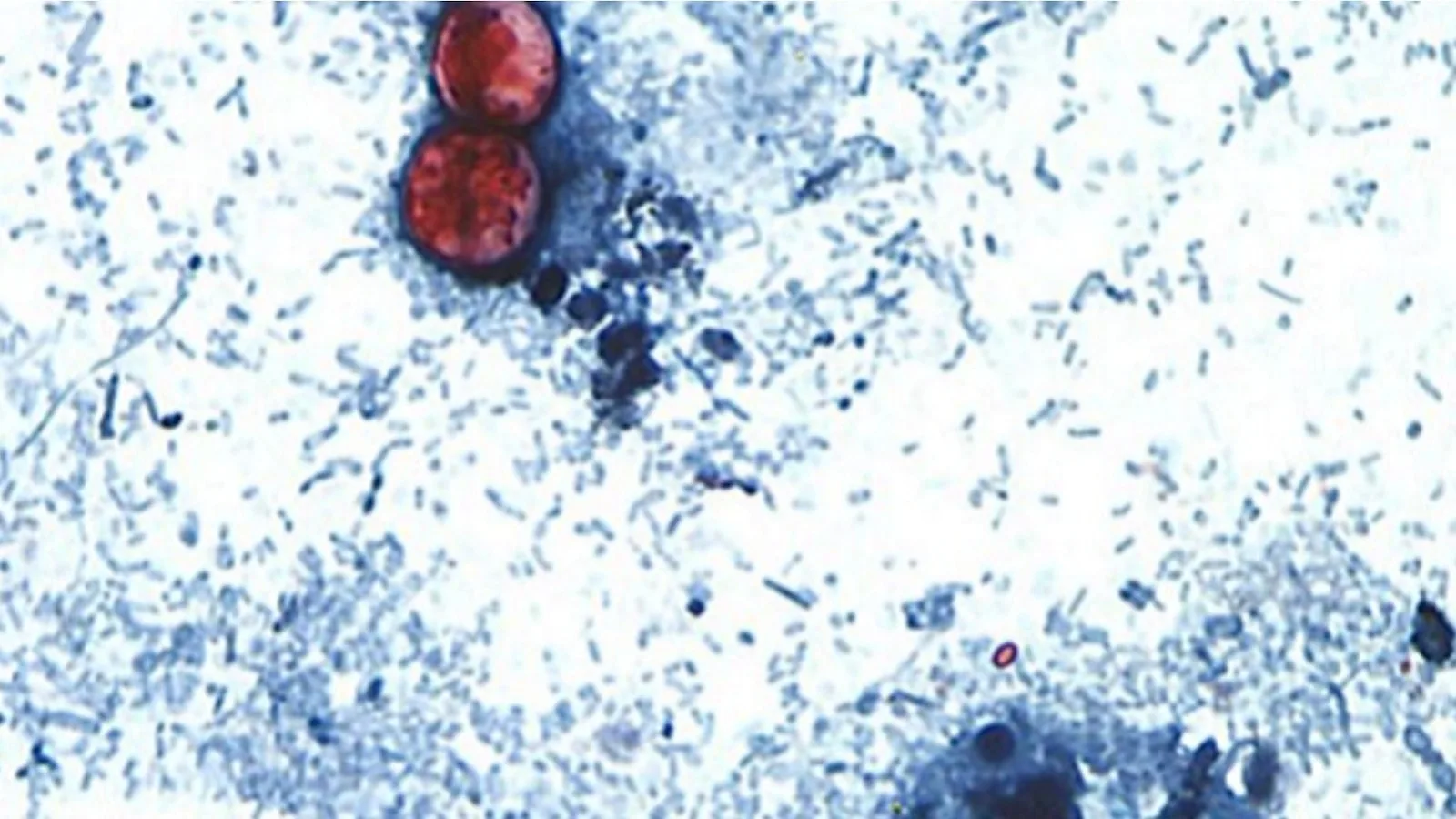 Cyclosporiasis Outbreak Linked to Mexican Lettuce Farm Affects Over 24,000 in US