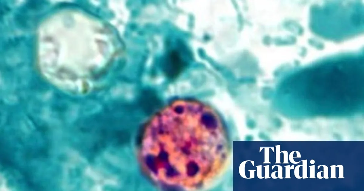Cyclospora Parasite Outbreak Leads to Surge in Illnesses Across Multiple US States
