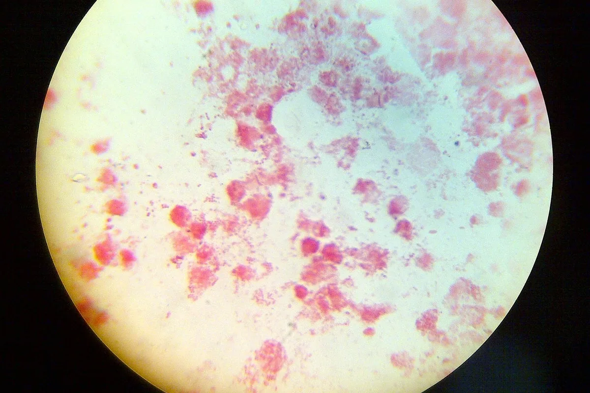 Gonorrhea and Syphilis Cases Reach Record Highs in Europe, Data Shows