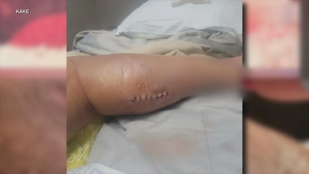 Kansas Mother Hospitalized After Multiple Spider Bites at Local Lake