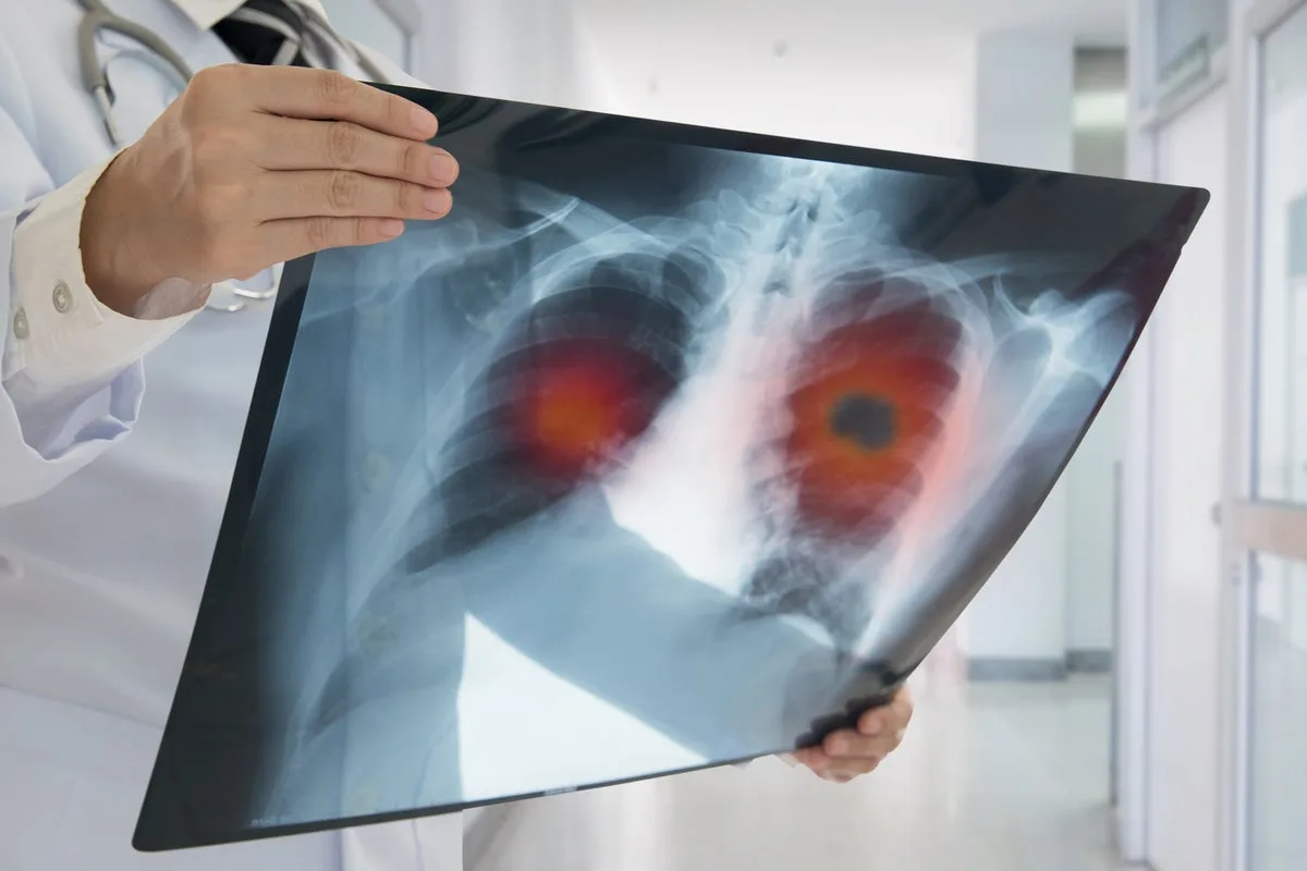 Lung Cancer Drug Ivonescimab Reduces Death Risk in Late-Stage China Trial