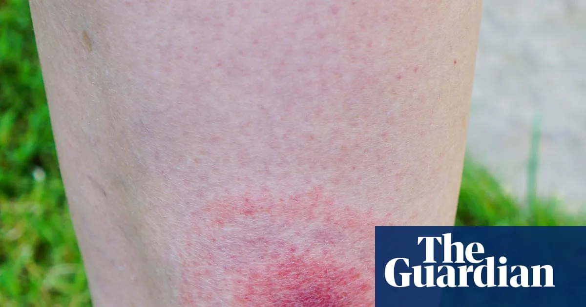 Lyme Disease Cases in England Increase by Over 20%, UKHSA Reports
