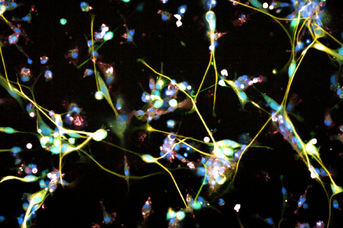 New CAR-T Cell Therapy Shows Potential Against Aggressive Glioblastoma in Study