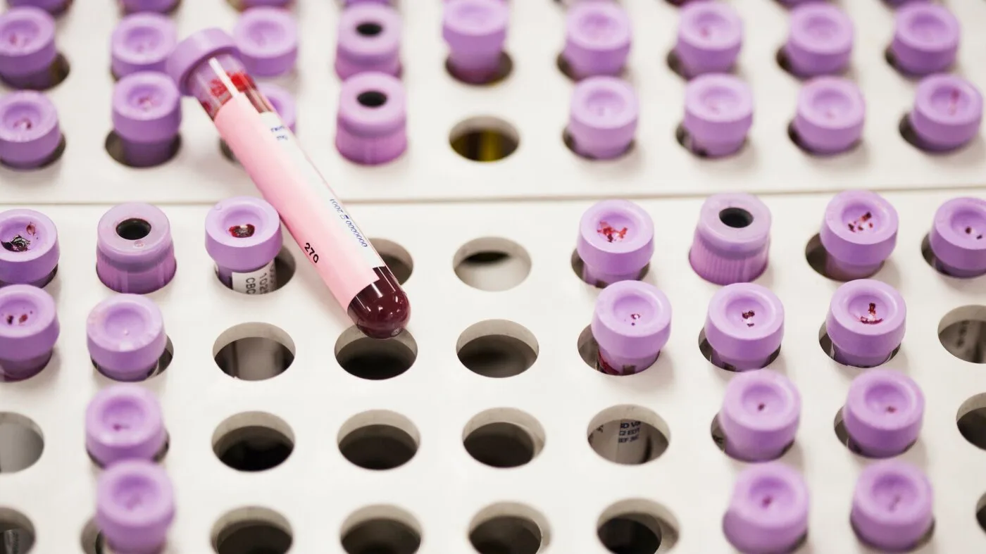 New Guidelines Recommend Earlier Cholesterol Testing and Treatment for Heart Disease Prevention