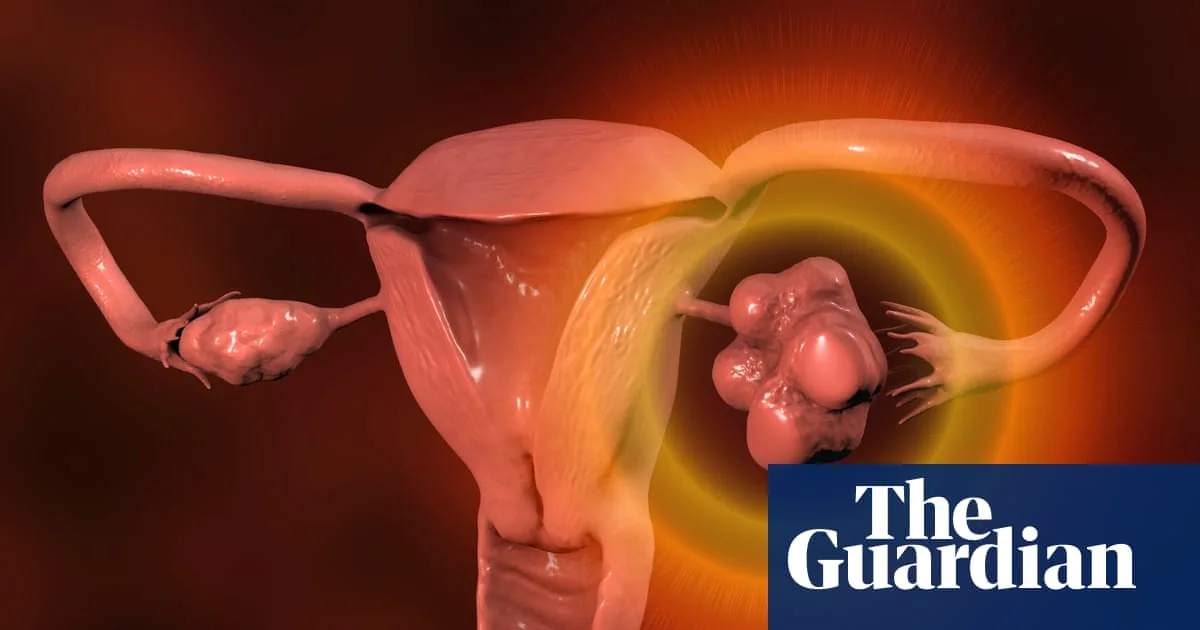NHS Issues New Guidance on Polyendocrine Metabolic Ovarian Syndrome Screening