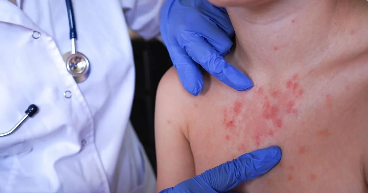 Pennsylvania Reports Fourth Measles-Related Death Amid Ongoing Outbreak