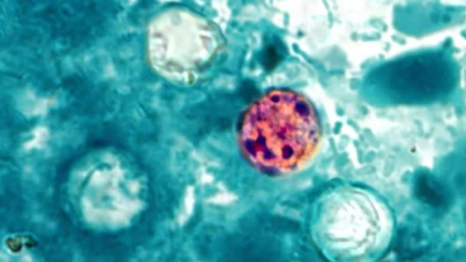 Cyclosporiasis Outbreak Reported Across U.S. and U.K., First Deaths in Michigan