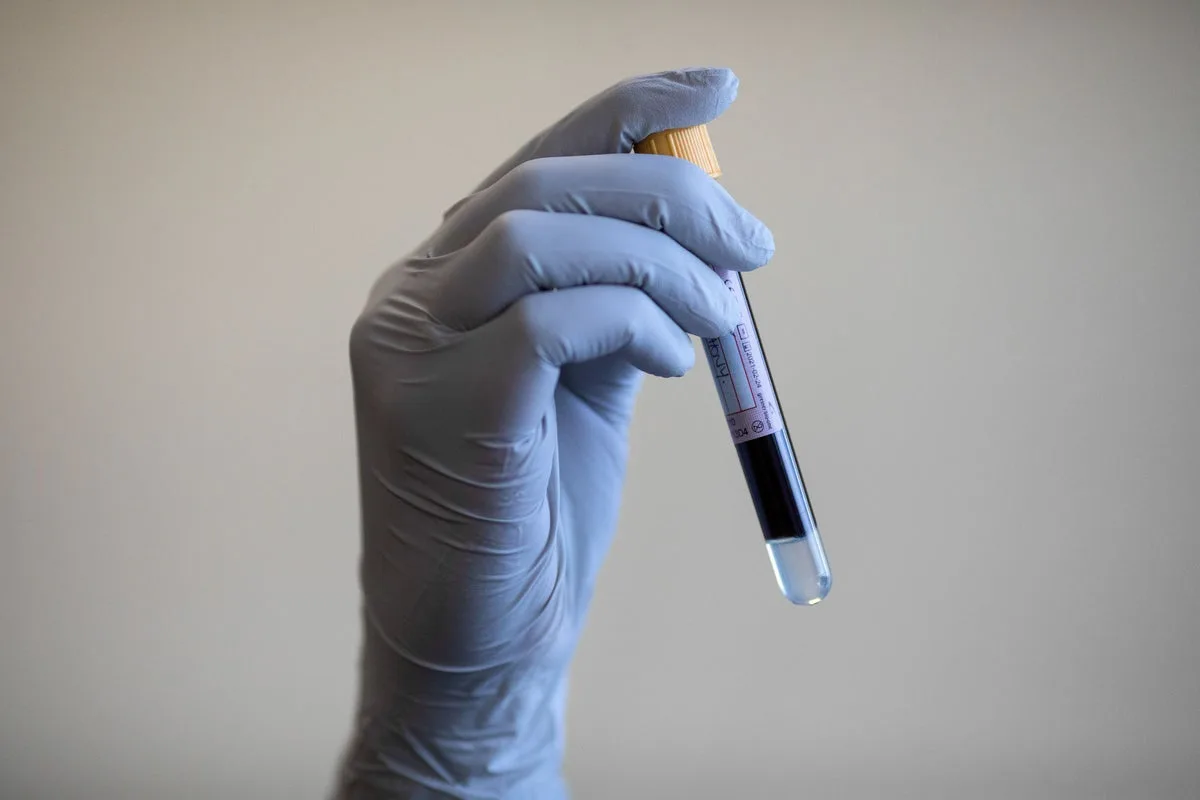 Study Suggests Blood Test May Detect Alzheimer’s Years Before Symptoms