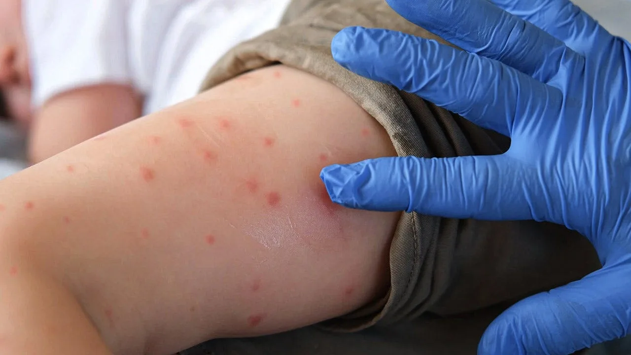 Two Unvaccinated Residents Die in Pennsylvania Measles Outbreak