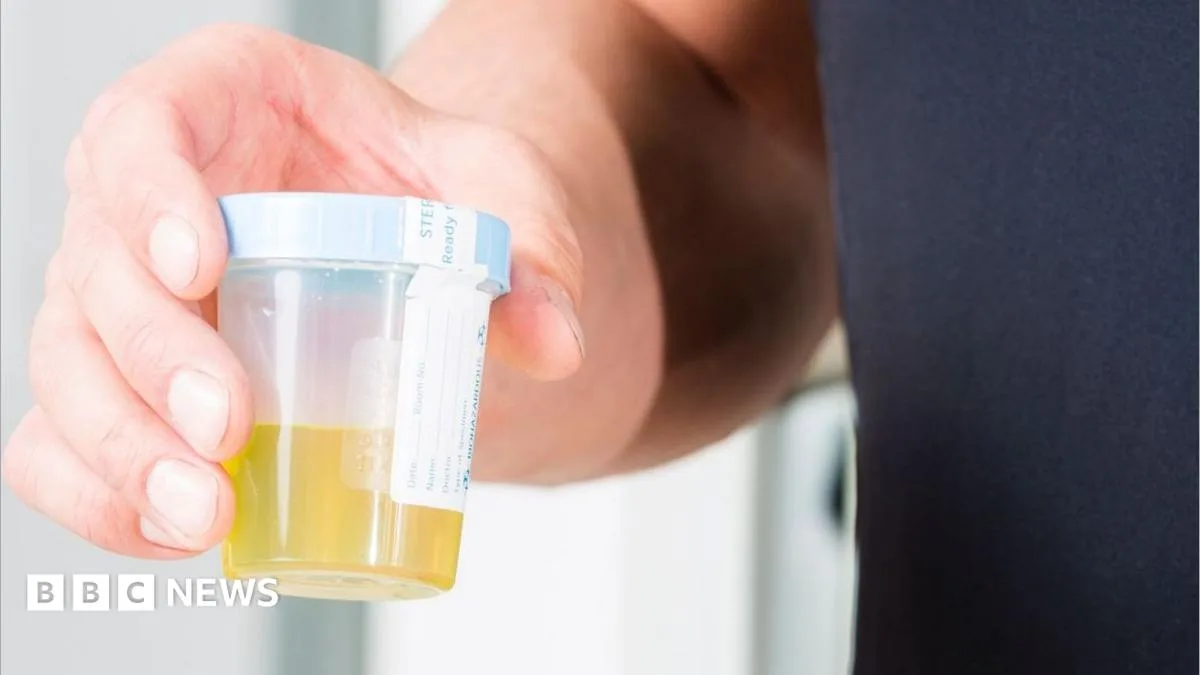 Urine Test Shows High Accuracy in Detecting Bladder Cancer in NHS Trials