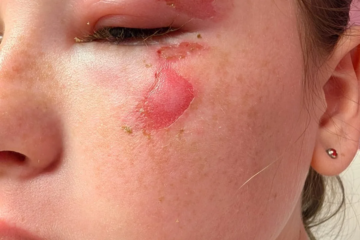 Warnings Issued After Children Burned by Exploding 'Squishy' Toys Heated in Microwaves
